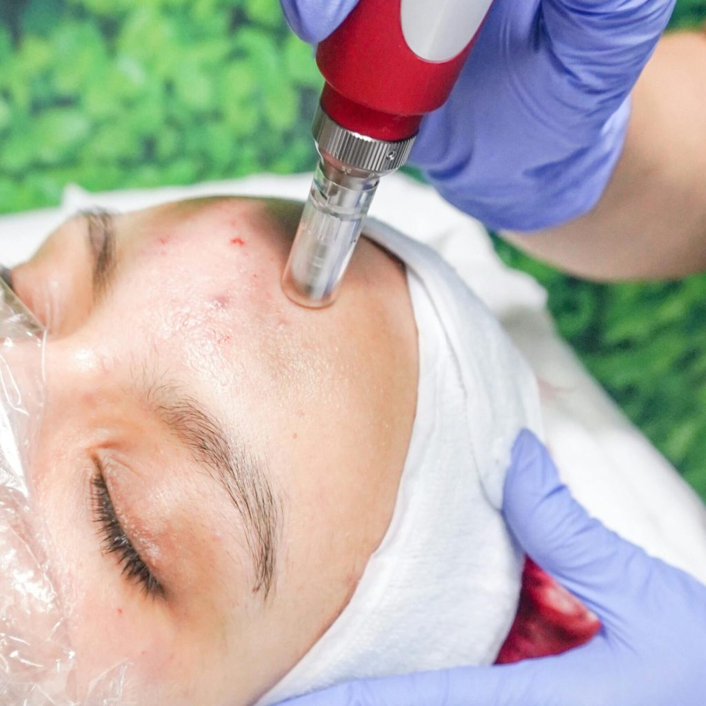 A woman receiving a professional microdermabrasion procedure for skincare improvement.